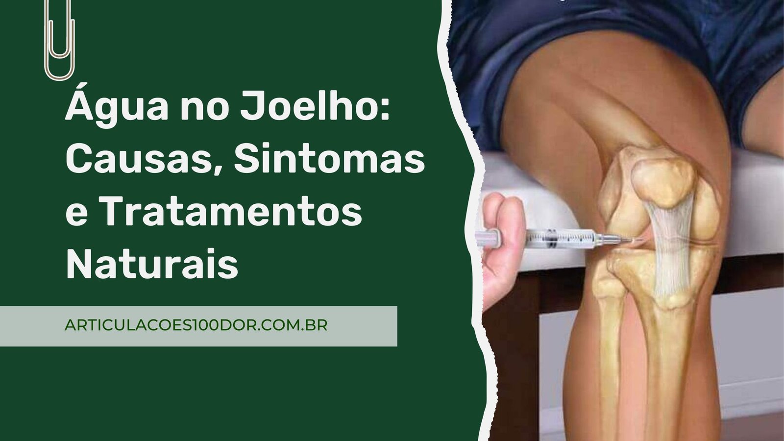 Água no Joelho: Causas, Sintomas e Tratamentos Naturais 1 Agua no Joelho